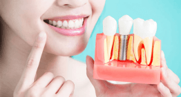 4 Reasons to Choose Dental Implants