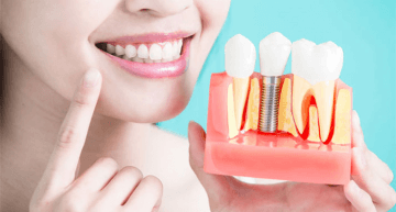 4 Reasons to Choose Dental Implants