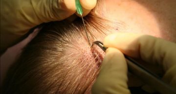 Natural Outcome is the Fundamental Aspect of the Hair Transplant Procedure