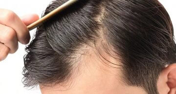 Stop the Hair Fall by Regular Intake of Propecia