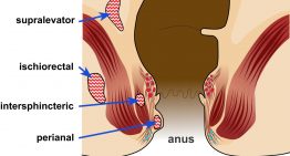 How long do hemorrhoids take to heal?