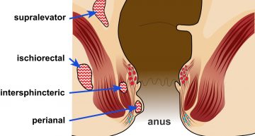 How long do hemorrhoids take to heal?